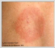 This is called a Erythema Migrans rash. If you get this especially after a none tick bite it is a de facto diagnosis of Lyme and you should be treated. However, fewer than 50% of people will develop an EM rash